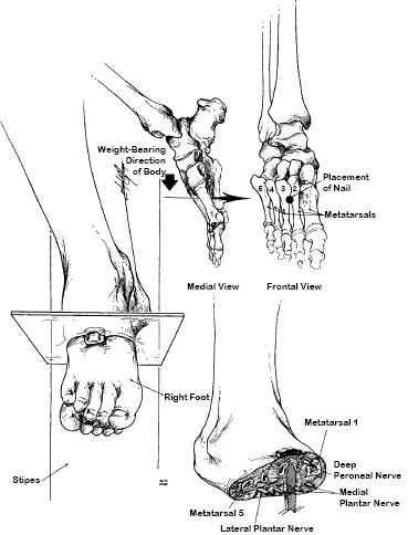 Blessure d'un clou dans les pieds Blessure d'un clou dans les pieds