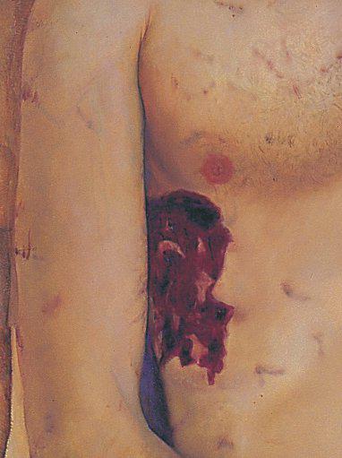 Une plaie causée par un objet pointu et large Une plaie causée par un objet pointu et large